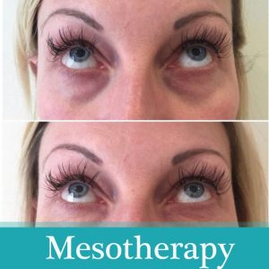 Read more about the article Why is hyaluronic acid used in mesotherapy?