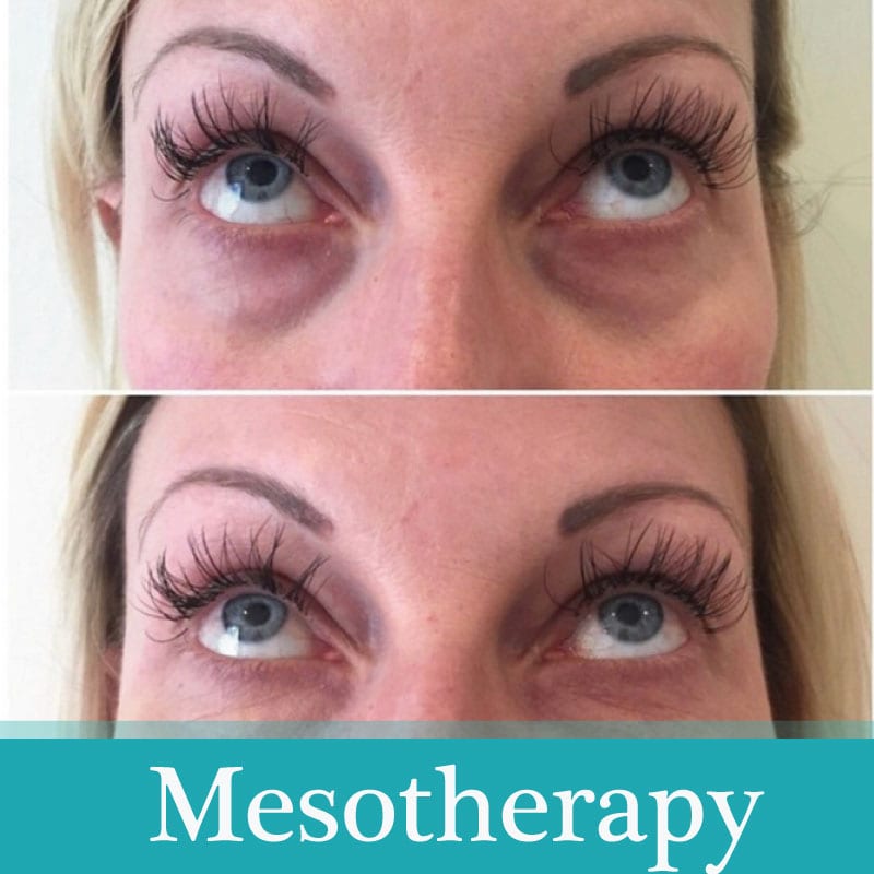 Read more about the article Why is hyaluronic acid used in mesotherapy?