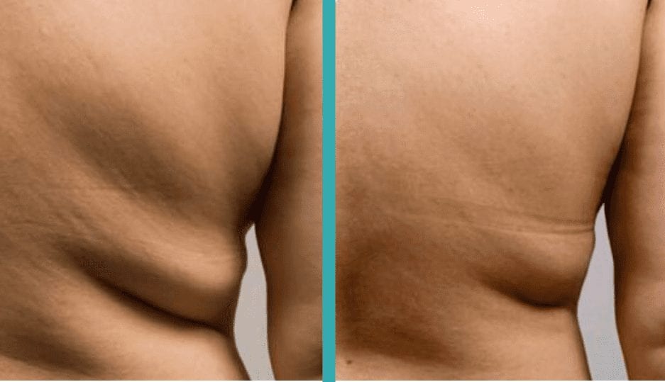 Best CoolSculpting chicago for men