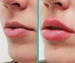 chicago lip injections