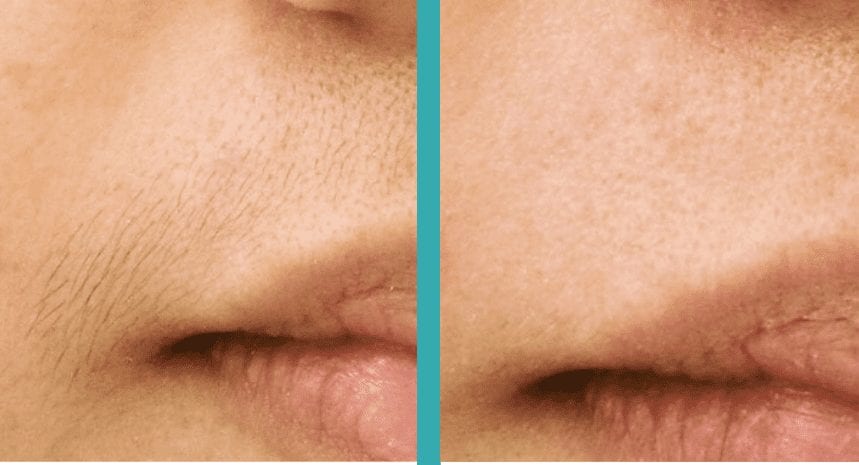 Lip laser hair removal chicago