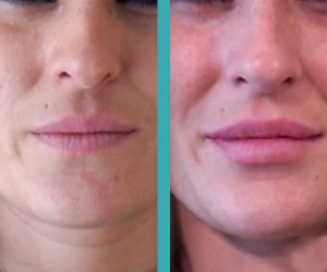 lip fillers before and after
