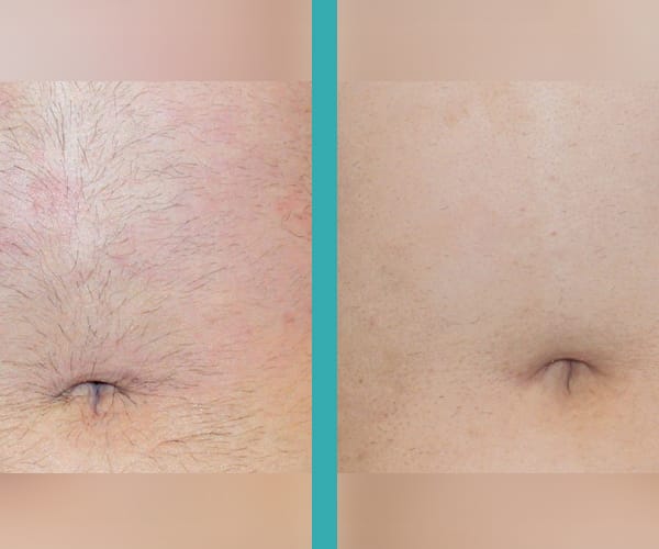 best laser hair removal chicago
