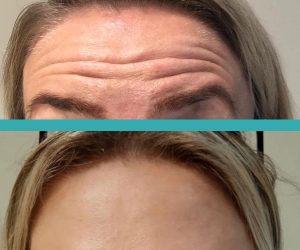 dramatic botox injections on forehead before and after