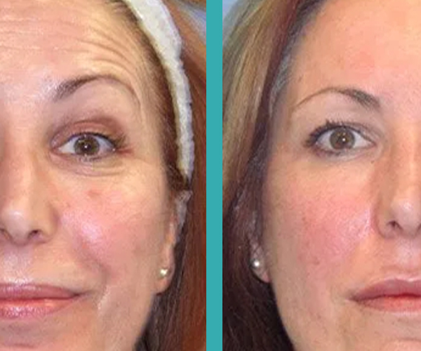 wrinkle reduction on forehead with Botox Injections