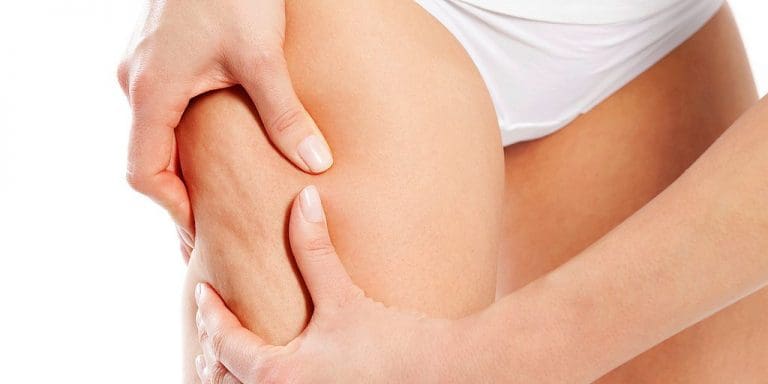 cellulite causes