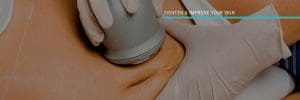 Read more about the article What are the side effects of Ultrasonic Cavitation?
