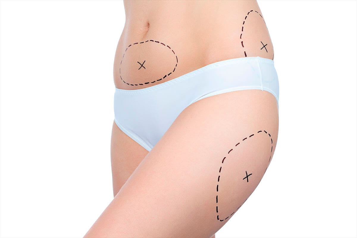 You are currently viewing History and Evolution of Laser Liposuction