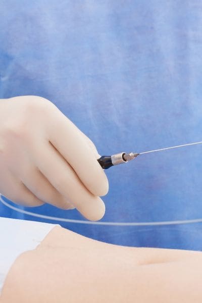 laser liposuction