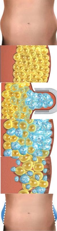 coolsculpting step by step graphic