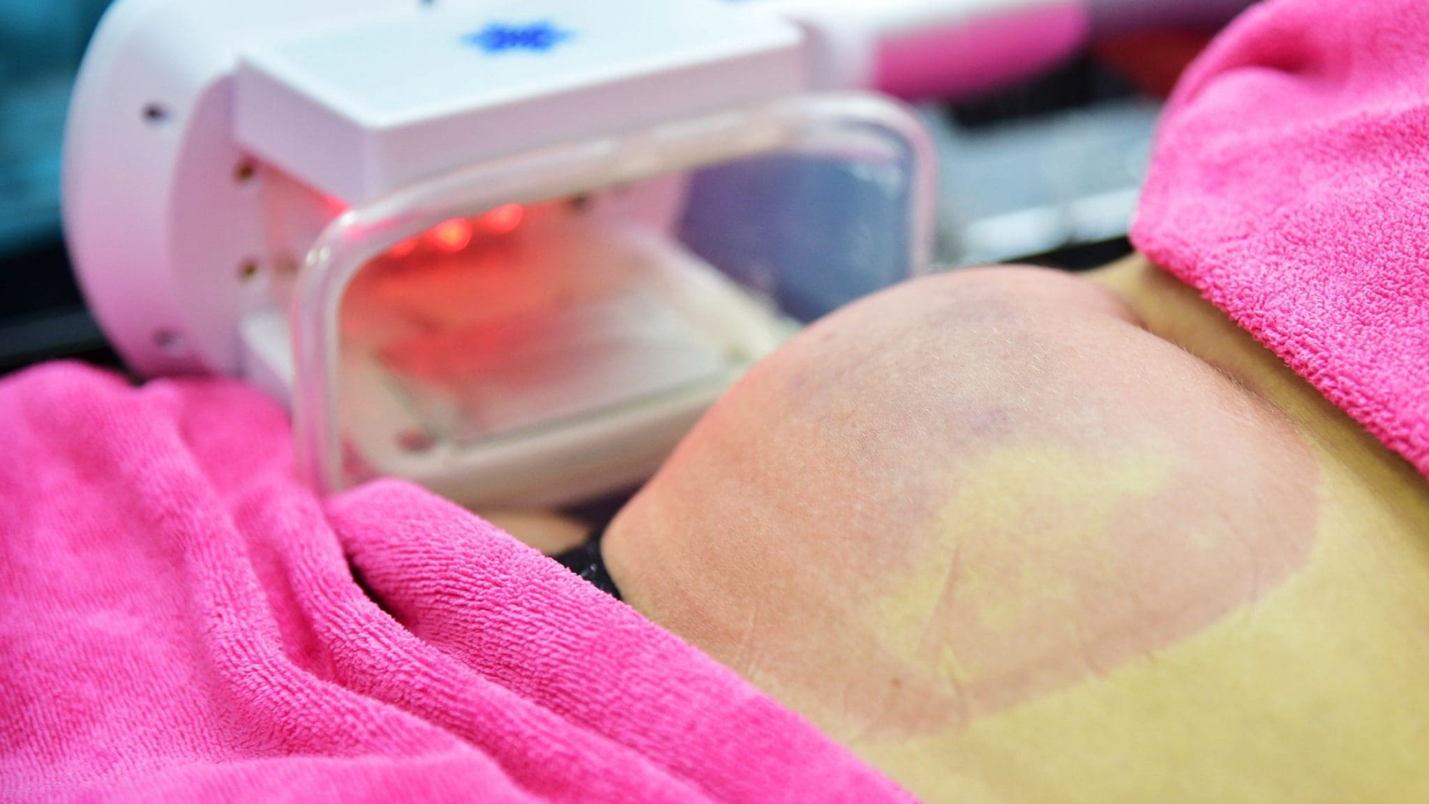You are currently viewing Coolsculpting Treatment Step by Step