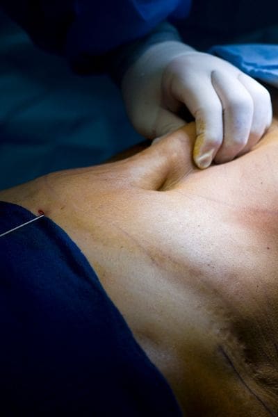liposuction risks