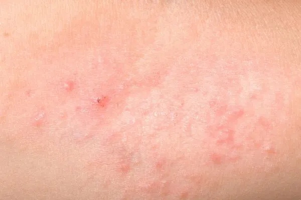 risk-of-cavitation-red-skin