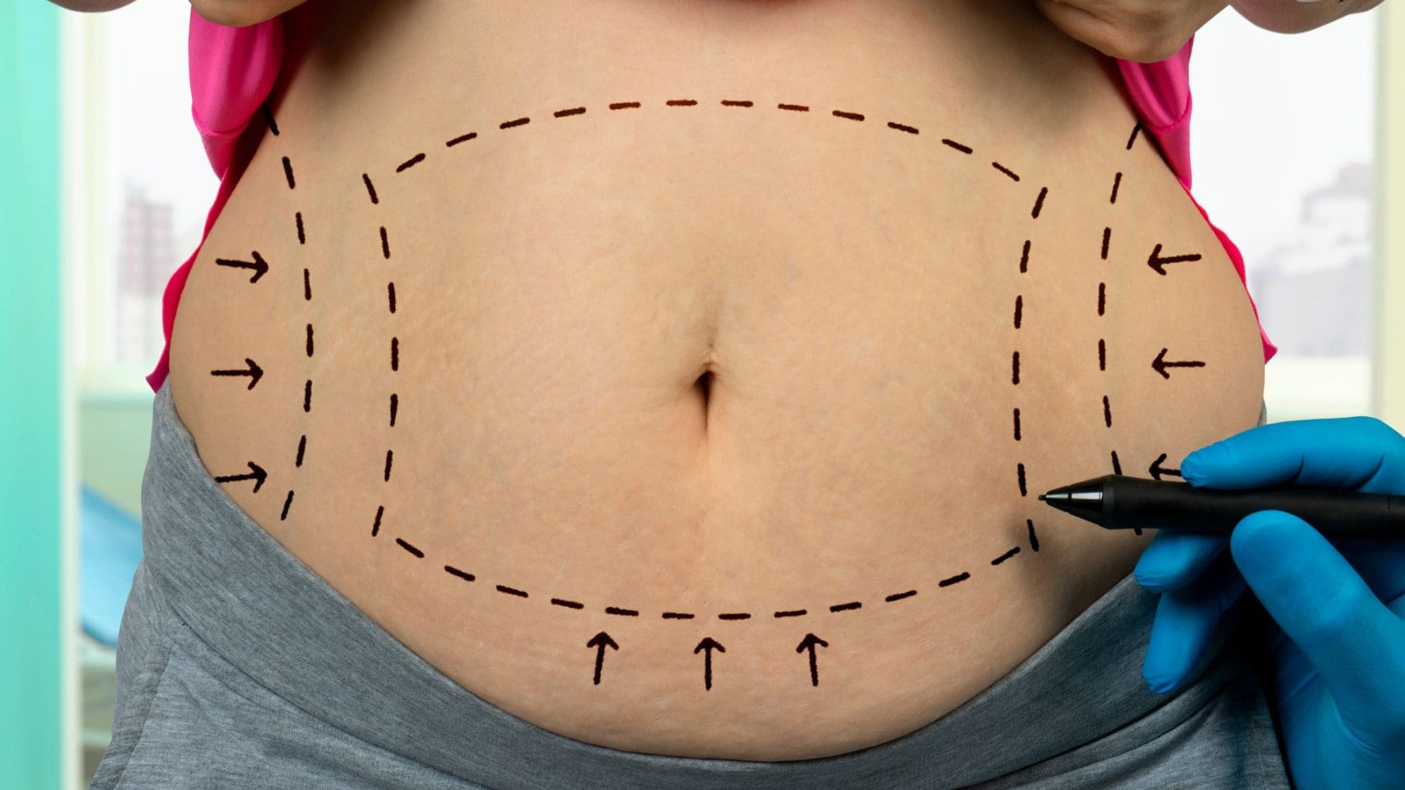 You are currently viewing Why Not to Have a Traditional Liposuction