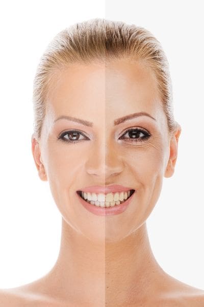 microderm facial results