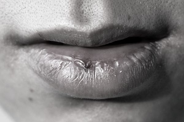 breaked lips need skincare for weather changes