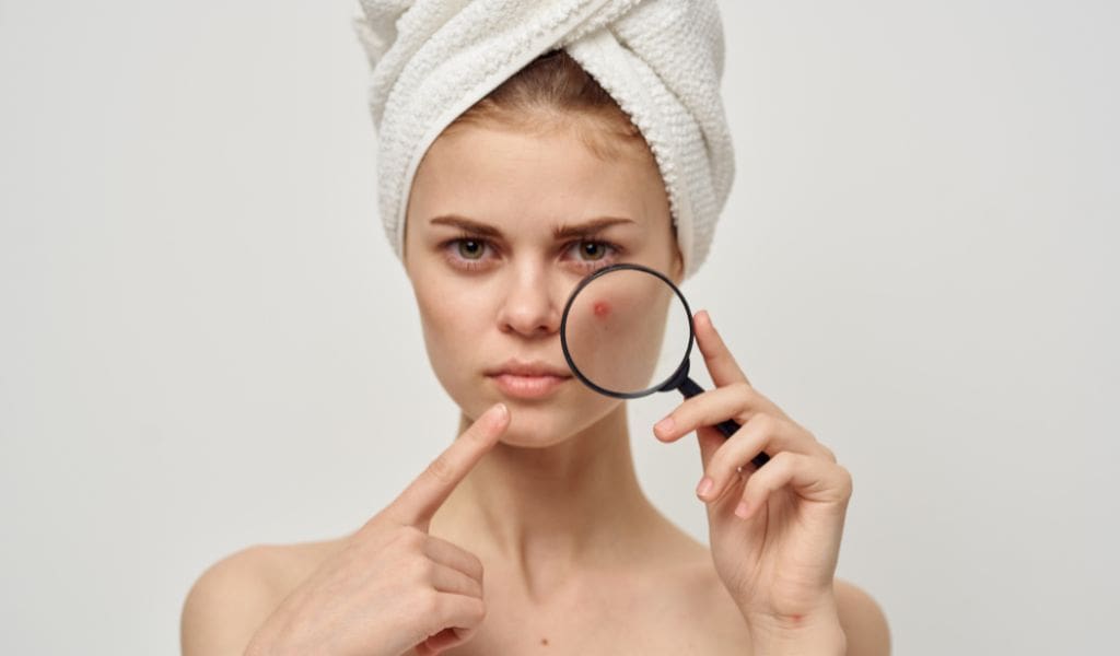 You are currently viewing Tips For Preventing Acne