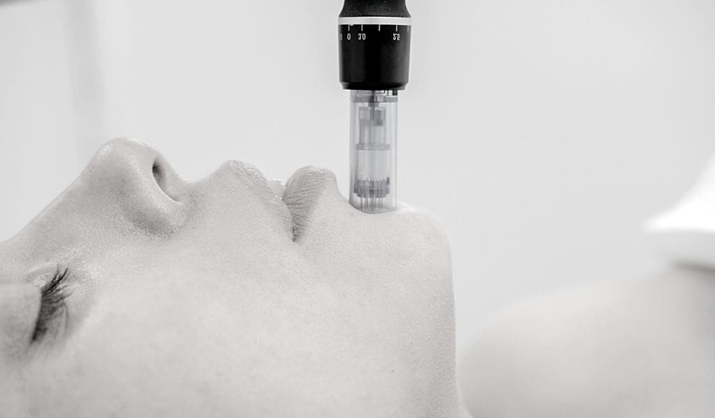 microneedling in chicago