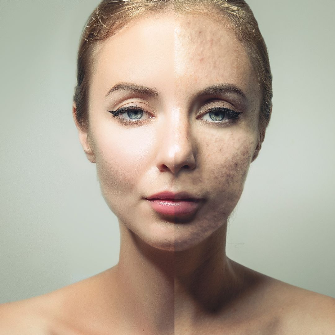 You are currently viewing How to fight skin blemishes?