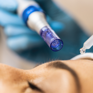 Microneedling Spa in Harwood Heights IL