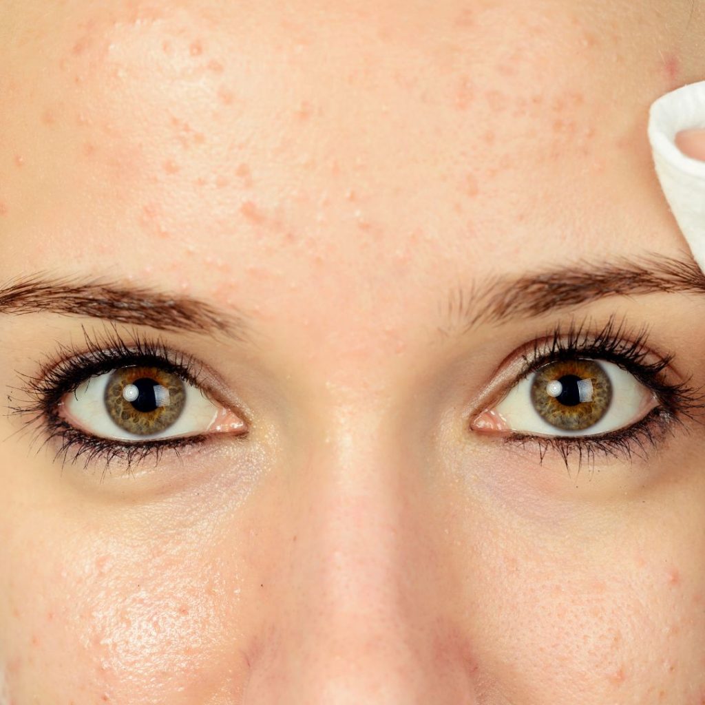 Is Dermaplaning Safe For All Skin Types - acne skin