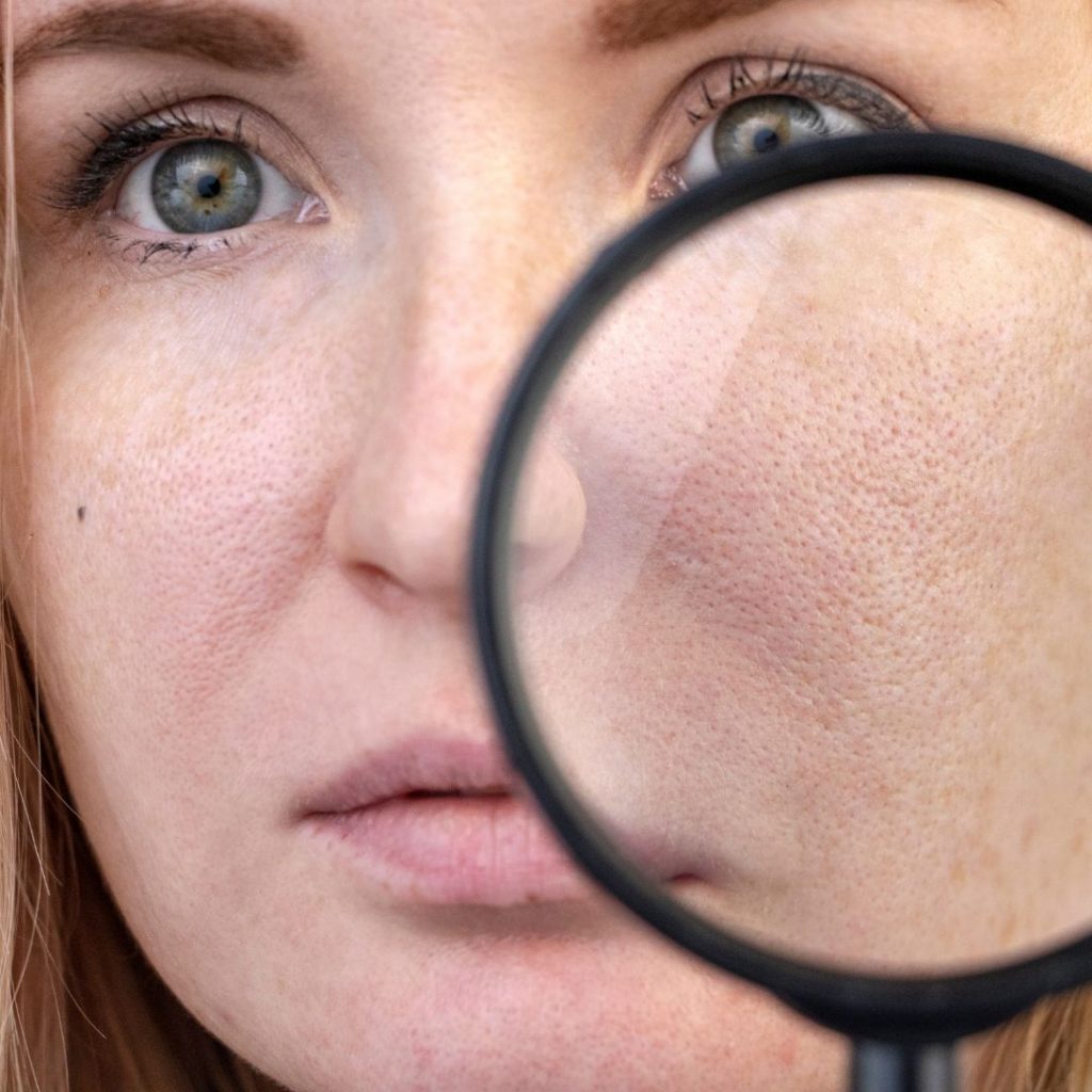 What Skin Conditions Can Be Treated With Microneedling - englared pores