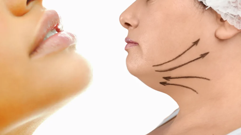 what-to-expect-with-coolsculpting-for-double-chin