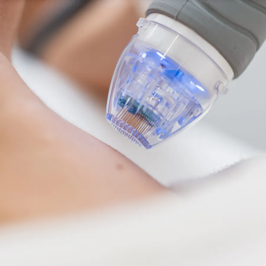 hair-growth-microneedling-for-hair-loss