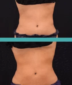 Before-and-After-Fat-Reduction-Abdomen-Elite-Chicago-Spa.webp