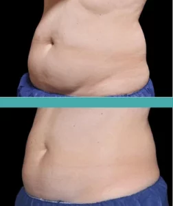 Before and After Fat Reduction of Female Patient-Coolsculpting