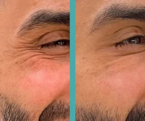 Male Patient in Chicago Before And After Botox Injections