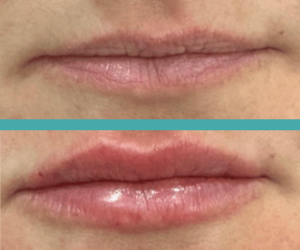 Before And After Lip Fillers in Elite Chicago Spa