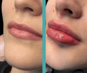 Before And After Lip Augmentation in Female patient in Chicago