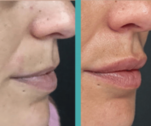 Before And After Lip Fillers in Woman in Chicago