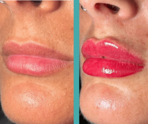 Woman with hot pink Lips Before And After her lip filler in chicago