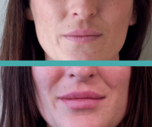 Before And After Results of Lip Filler in Elite Chicago Spa