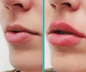 Lip-Injections-Chicago-Before-and-After