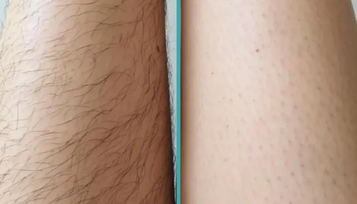 Can You Workout After Laser Hair Removal?