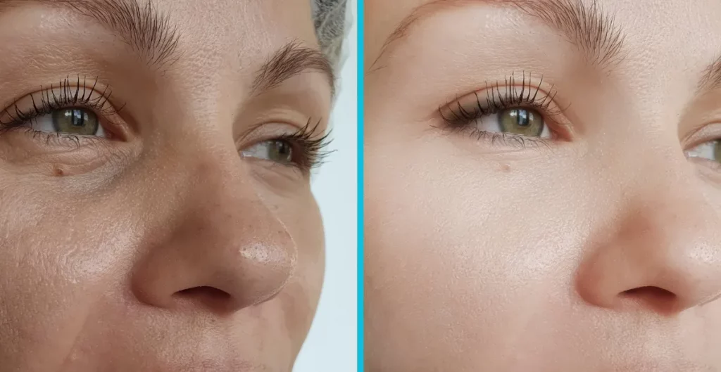 reviving-youth-with-thread-lift