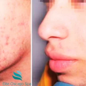 Acne Facial