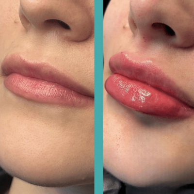 Before And After Lip Augmentation in Female patient in Chicago
