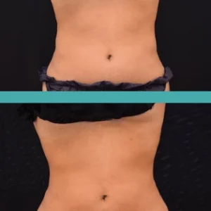 Before and After Fat Reduction Abdomen-Elite Chicago Spa