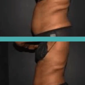 Before and After Fat Reduction of Female African American Patient