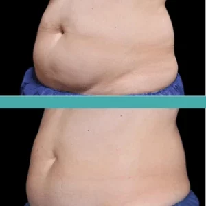 Before and After Fat Reduction of Female Patient-Coolsculpting