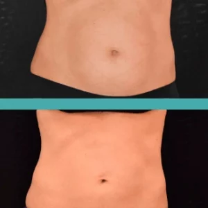 Before and After Fat Reduction of Abdomen