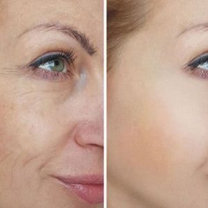 MICRONEEDLING-CON-02