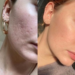 Microneedling Chicago