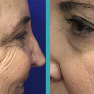 Crows feet botox before and after on woman