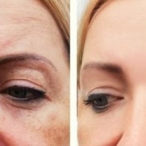 -microneedling-