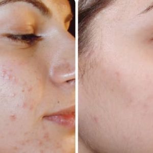 microneedling